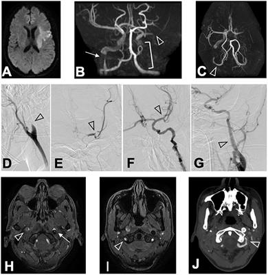 Case Report: Spontaneous Postpartum Quadruple Cervicocephalic Arterial Dissection With a Heterozygous COL5A1 Variant of Unknown Significance